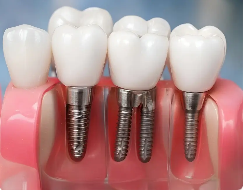 Close up view of a multi implant bridge model illustrating secure tooth restoration options.